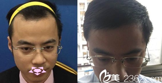 方蜜發(fā)際線種植案例 方蜜發(fā)際線種植案例