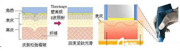 熱瑪吉適用人群