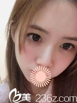 韓國(guó)枓翰整形面部填充術(shù)后30天照