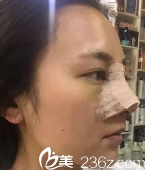 駐馬店美蘭德做鼻綜合手術(shù)當(dāng)天 駐馬店美蘭德做鼻綜合手術(shù)當(dāng)天