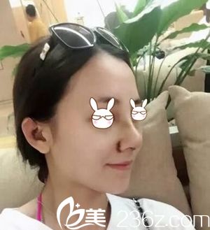 駐馬店美蘭德做鼻綜合手術(shù)第二天 駐馬店美蘭德做鼻綜合手術(shù)第二天