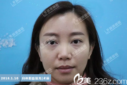 在深圳麗港麗格整形醫(yī)院做脂肪填充前