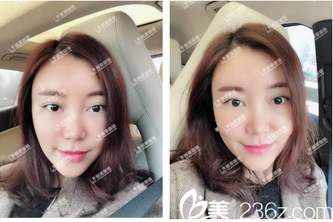 自體脂肪面部填充術(shù)后兩周圖片