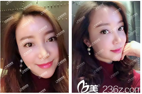 自體脂肪填充全臉術(shù)后一個(gè)月