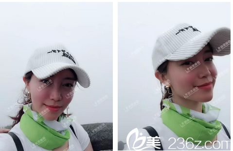 做完自體脂肪填充全臉術(shù)后兩個(gè)月