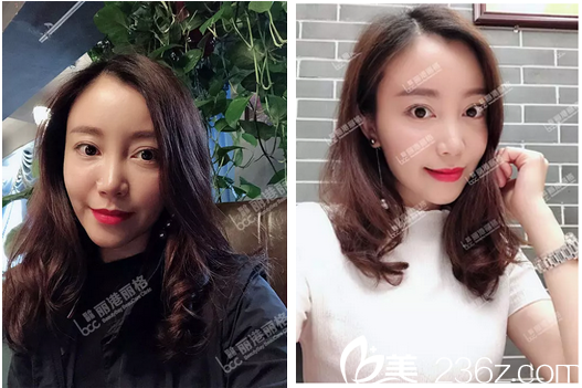 深圳麗港麗格謝俊做的自體脂肪面部填充全臉案例圖