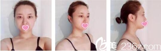 韓國DrBe整形外科<!--<i data=20240703-sp></i>-->金泰中面部埋線提升真人案例術前照 韓國DrBe整形外科<!--<i data=20240703-sp></i>-->金泰中面部埋線提升真人案例術前照