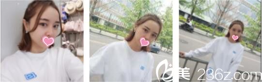 韓國DrBe整形外科<!--<i data=20240703-sp></i>-->金泰中面部埋線提升真人案例術后第十天 韓國DrBe整形外科<!--<i data=20240703-sp></i>-->金泰中面部埋線提升真人案例術后第十天