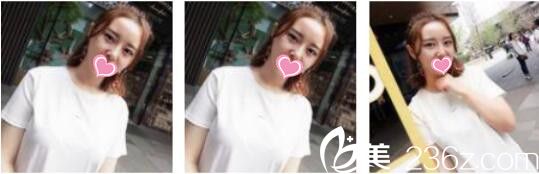 韓國DrBe整形外科<!--<i data=20240703-sp></i>-->金泰中面部埋線提升真人案例術后一個月 韓國DrBe整形外科<!--<i data=20240703-sp></i>-->金泰中面部埋線提升真人案例術后一個月