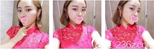 韓國DrBe整形外科<!--<i data=20240703-sp></i>-->金泰中面部埋線提升真人案例術后兩個月 韓國DrBe整形外科<!--<i data=20240703-sp></i>-->金泰中面部埋線提升真人案例術后兩個月