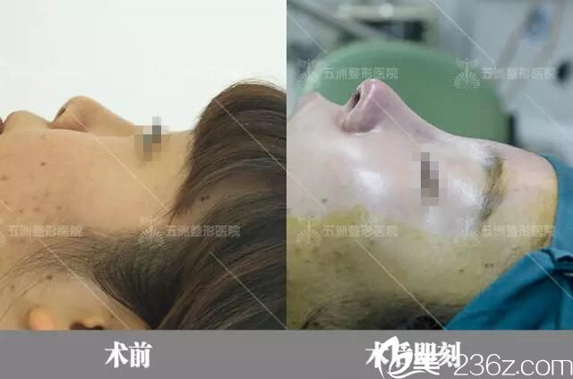 術(shù)后即刻對比效果 術(shù)后即刻對比效果