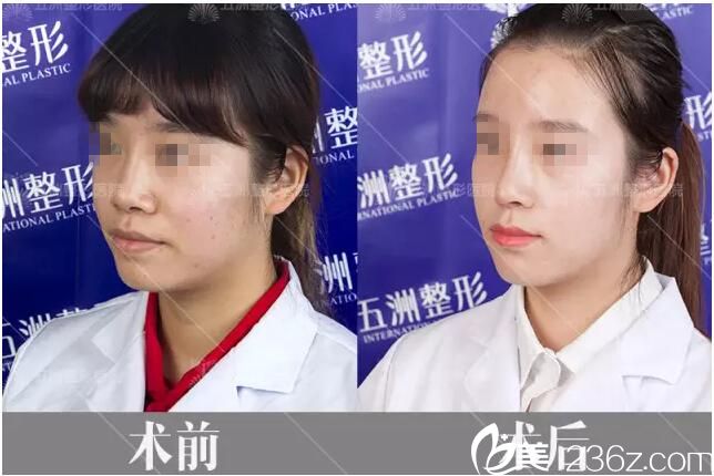 術(shù)后15天側(cè)面對比效果 術(shù)后15天側(cè)面對比效果