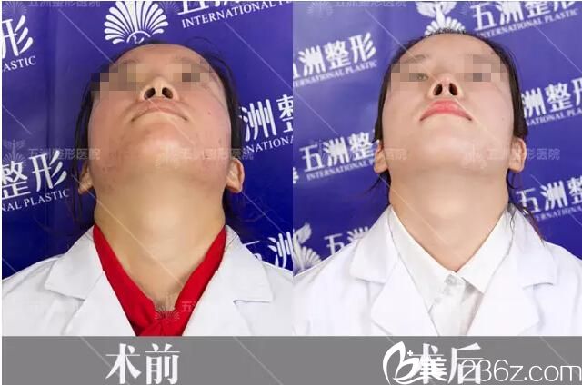 術(shù)后15天仰面對比效果 術(shù)后15天仰面對比效果