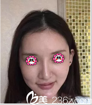 在北京葉子做埋線提升前樣子 在北京葉子做埋線提升前樣子