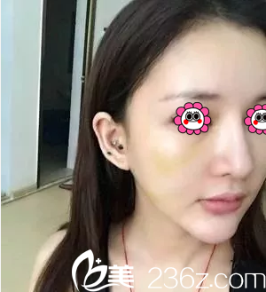 北京葉子楊峰給我做埋線提升第4天樣子 北京葉子楊峰給我做埋線提升第4天樣子