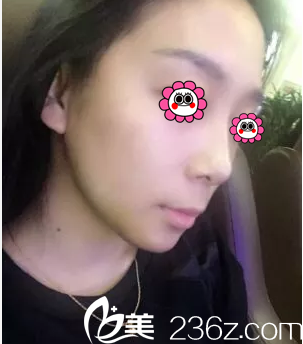 在北京葉子做意大利悅生線埋線提升第13天效果 在北京葉子做意大利悅生線埋線提升第13天效果