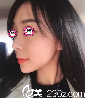 北京葉子埋線提升案例 北京葉子埋線提升案例