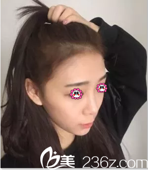 北京葉子楊峰意大利悅升線埋線提升真實效果分享