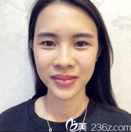 在深圳妍熙整形醫(yī)院做鼻修復(fù)手術(shù)前