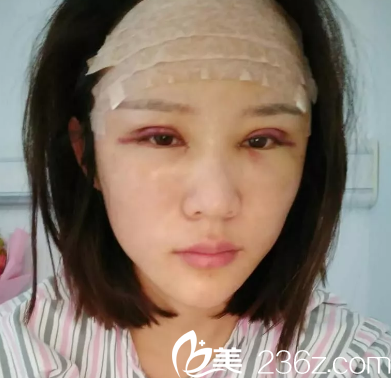 我還做了自體脂肪填充額頭