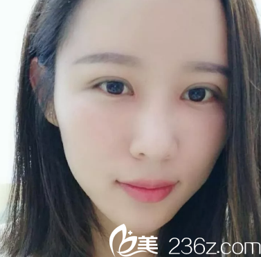 大家看我的眼睛恢復(fù)的怎么樣啊