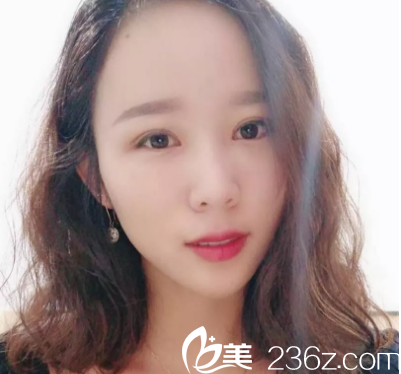 濟南美蓮做雙眼皮手術(shù)挺厲害的，分享我在濟南美蓮做全切雙眼皮半年恢復(fù)歷程