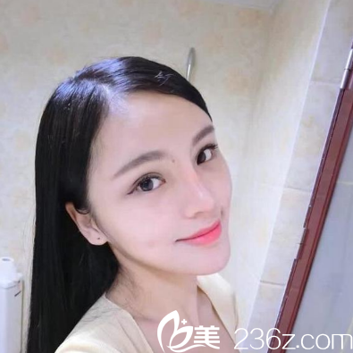 深圳鵬程<!--<i data=20240703-sp></i>-->醫(yī)生隆鼻案例一個(gè)月圖片 深圳鵬程<!--<i data=20240703-sp></i>-->醫(yī)生隆鼻案例一個(gè)月圖片