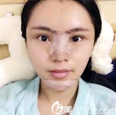 深圳鵬程<!--<i data=20240703-sp></i>-->隆鼻案例術(shù)后5天圖片 深圳鵬程<!--<i data=20240703-sp></i>-->隆鼻案例術(shù)后5天圖片