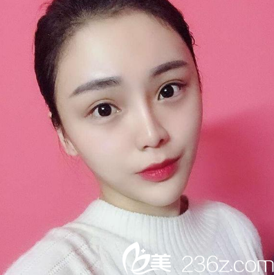 深圳鵬程<!--<i data=20240703-sp></i>-->醫(yī)生做的隆鼻案例照片 深圳鵬程<!--<i data=20240703-sp></i>-->醫(yī)生做的隆鼻案例照片