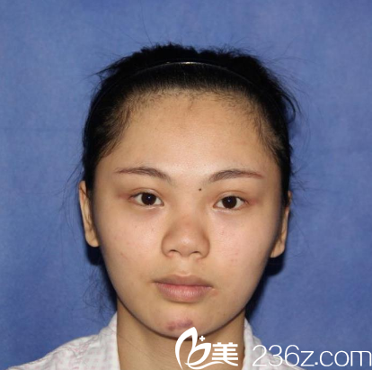 在深圳鵬程整形醫(yī)院隆鼻手術(shù)前 在深圳鵬程整形醫(yī)院隆鼻手術(shù)前