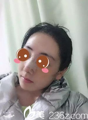 祁永章院長(zhǎng)鼻綜合手術(shù)<span style=