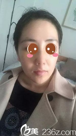 鼻綜合手術(shù)7天了，去拆線