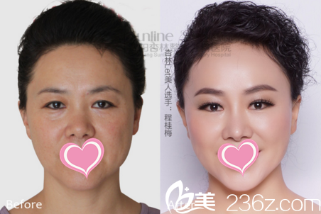 沈陽(yáng)杏林激光祛斑美膚真人對(duì)比照