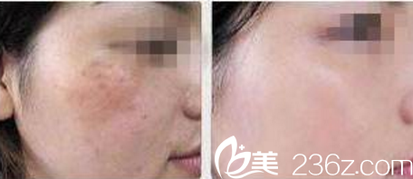 遼寧沈陽(yáng)激光祛斑真人對(duì)比照