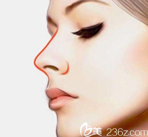 杭州做假體隆鼻醫(yī)生及手術(shù)價(jià)格