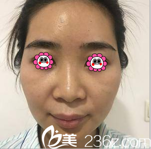 在北京亞韓做脂肪填充前樣子 在北京亞韓做脂肪填充前樣子