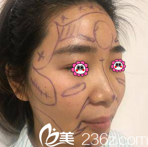 亞韓醫(yī)生給我進(jìn)行V塑加面部脂肪填充設(shè)計(jì)照 亞韓醫(yī)生給我進(jìn)行V塑加面部脂肪填充設(shè)計(jì)照