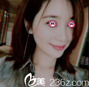 在北京亞韓做V塑加面部脂肪填充第35天效果 在北京亞韓做V塑加面部脂肪填充第35天效果