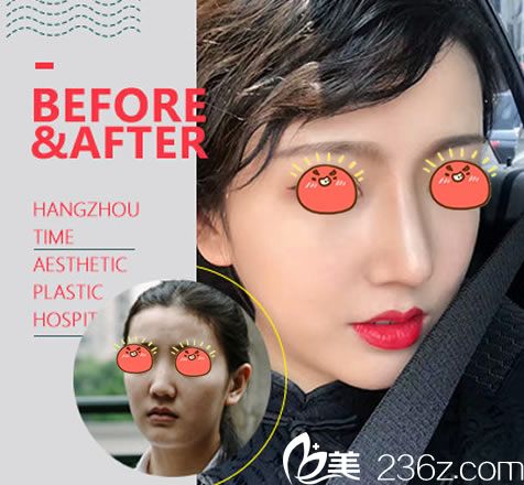 杭州時(shí)光整形張常院長(zhǎng)鼻綜合案例