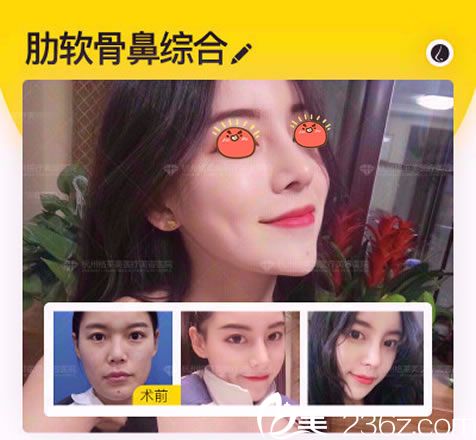 格萊美張龍?jiān)洪L(zhǎng)肋軟骨鼻綜合案例