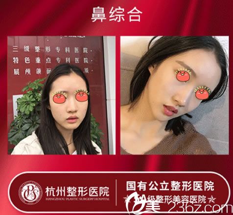 唐冬生主任肋軟骨鼻綜合案例