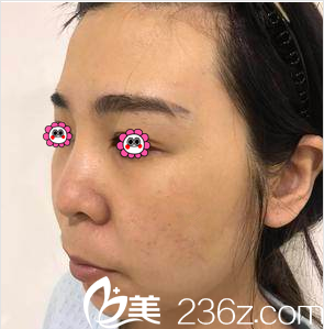 在北京亞韓做面部吸脂前樣子 在北京亞韓做面部吸脂前樣子