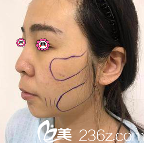 醫(yī)生給我做V塑減面部吸脂設(shè)計(jì)照 醫(yī)生給我做V塑減面部吸脂設(shè)計(jì)照