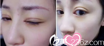 雙眼皮修復(fù)手術(shù)后第5天