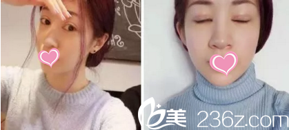 雙眼皮修復(fù)手術(shù)第7天效果