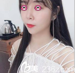 我在北京亞韓做V塑減面部吸脂第48天效果 我在北京亞韓做V塑減面部吸脂第48天效果