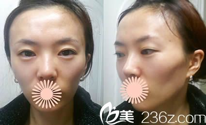 韓國麗珍整形醫(yī)院手術(shù)當(dāng)天拍的照 韓國麗珍整形醫(yī)院手術(shù)當(dāng)天拍的照