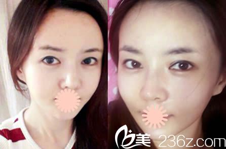 韓國麗珍整形醫(yī)院如何？用我面部輪廓整形和自體脂肪填充的真實(shí)案例來回答