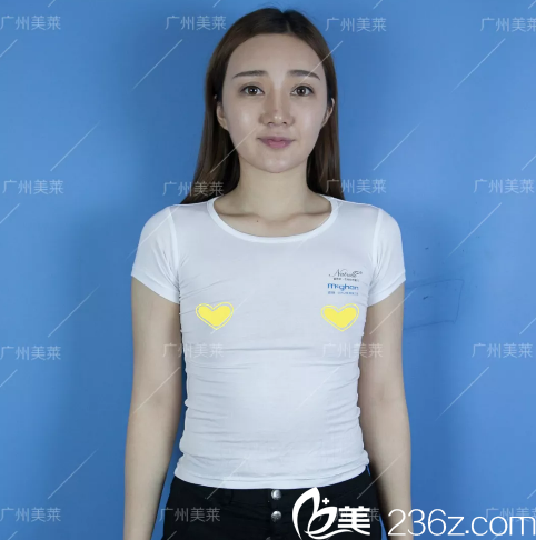 在廣州美萊做假體隆胸手術(shù)前