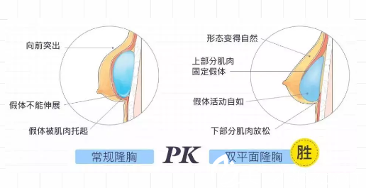 常規(guī)隆胸和內(nèi)窺鏡雙平面隆胸對比